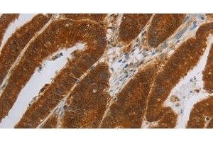 Immunohistochemistry of paraffin-embedded Human colon cancer using NIT2 Polyclonal Antibody at dilution of 1:40