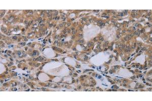 Immunohistochemistry of paraffin-embedded Human thyroid cancer tissue using NAIP Polyclonal Antibody at dilution 1:30 (NAIP 抗体)