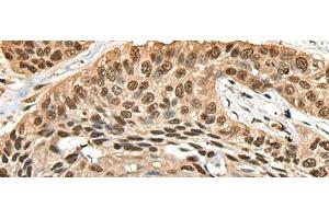 Immunohistochemistry of paraffin-embedded Human esophagus cancer tissue using CCDC112 Polyclonal Antibody at dilution of 1:45(x200) (CCDC112 抗体)