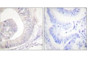 Immunohistochemistry analysis of paraffin-embedded human colon carcinoma, using HSL (Phospho-Ser855/554) Antibody. (LIPE 抗体  (pSer855))