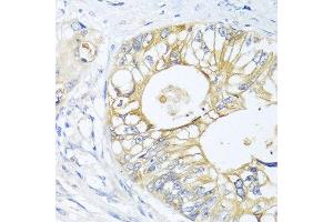 Immunohistochemistry of paraffin-embedded human colon carcinoma using GNAI3 antibody at dilution of 1:100 (40x lens). (GNAI3 抗体)