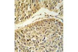 Formalin fixed paraffin embedded lung carcinoma stained with RERE Antibody (N-term) followed by peroxidase conjugation of the secondary antibody and DAB staining. (RERE 抗体  (N-Term))