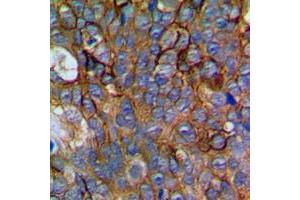 Immunohistochemical analysis of NCALD staining in human prostate cancer formalin fixed paraffin embedded tissue section. (NCALD 抗体  (Center))