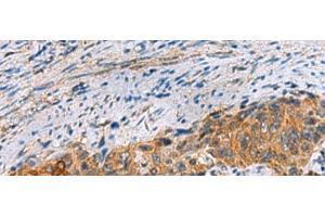 Immunohistochemistry of paraffin-embedded Human cervical cancer tissue using JOSD1 Polyclonal Antibody at dilution of 1:70(x200) (JOSD1 抗体)