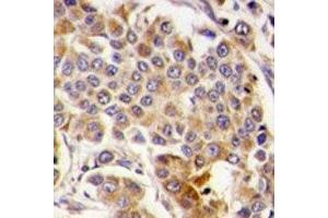 IHC analysis of FFPE human breast carcinoma tissue stained with AMPK antibody (PRKAA1 抗体  (AA 474-502))