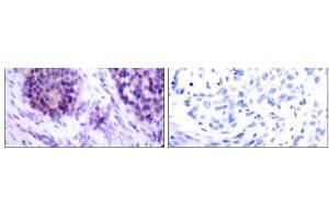 Immunohistochemical analysis of paraffin-embedded human breast carcinoma tissue using BCL-XL (phospho-Ser62) antibody (E011066). (BCL2L1 抗体  (pSer62))