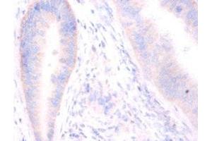 Immunohistochemistry of paraffin-embedded human colon cancer using ABIN7171243 at dilution of 1:100 (Syntaxin 6 抗体  (AA 5-234))