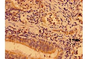 IHC image of ABIN7160061 diluted at 1:400 and staining in paraffin-embedded human lung cancer performed on a Leica BondTM system. (MAP3K9 抗体  (AA 864-1098))