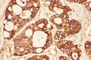 Anti-Src Picoband antibody,  IHC(P): Human Intestinal Cancer Tissue (Src 抗体  (AA 2-368))