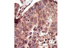 Formalin-fixed and paraffin-embedded human cancer tissue reacted with the primary antibody, which was peroxidase-conjugated to the secondary antibody, followed by AEC staining. (PKLR 抗体  (C-Term))