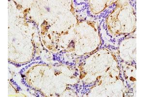 Formalin-fixed and paraffin embedded human colon carcinoma labeled with Anti-CEA(B5) Monoclonal Antibody, Unconjugated (bsm-1624M) at 1:200 followed by conjugation to the secondary antibody and DAB staining (CEA 抗体)