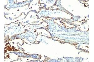 FFPE human lung carcinoma tested with MFG-E8 antibody (SPM291) (MFGE8 抗体)