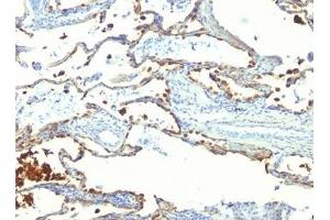 FFPE human lung carcinoma tested with MFG-E8 antibody (SPM291)