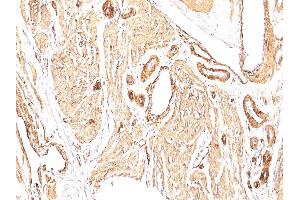 Formalin-fixed, paraffin-embedded human Leiomyosarcoma stained with Smooth Muscle Actin Mouse Monoclonal Antibody (1A4). (Smooth Muscle Actin 抗体  (N-Term))