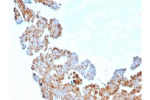 Formalin-fixed, paraffin-embedded human Breast Carcinoma stained with CDC34 Mouse Monoclonal Antibody (CPTC-CDC34-2). (CDC34 抗体)