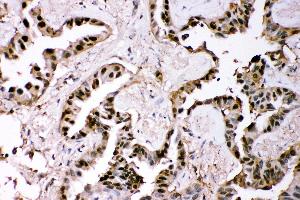 Anti- GST3/GST pi Picoband antibody, IHC(P) IHC(P): Human Lung Cancer Tissue (GSTP1 抗体  (AA 2-210))