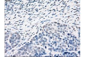 Immunohistochemical staining of paraffin-embedded Adenocarcinoma of colon tissue using anti-PPP5Cmouse monoclonal antibody. (PP5 抗体)
