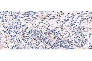 Immunohistochemistry of paraffin-embedded Human cervical cancer tissue using GKAP1 Polyclonal Antibody at dilution of 1:95(x200) (GKAP1 抗体)