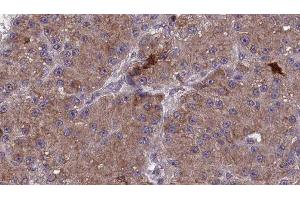 ABIN6277856 at 1/100 staining Human liver cancer tissue by IHC-P. (MAG 抗体  (C-Term))