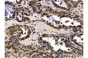ABIN6257506 and ABIN6274319 at 1/100 staining human ovarian cancer by IHC-P.