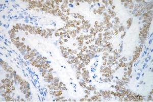 Immunohistochemistry was performed on paraffin-embedded human sigmoid colon carcinoma using checkpoint kinase 2 antibody (ABIN7798040), 1:200). (Recombinant CHEK2 抗体)