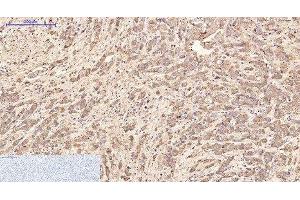 Immunohistochemistry of paraffin-embedded Human breast cancer tissue using AFP Monoclonal Antibody at dilution of 1:200. (alpha Fetoprotein 抗体)