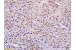 Formalin-fixed and paraffin embedded human cervical carcinoma labeled with Anti-WAPL Polyclonal Antibody, Unconjugated (ABIN872457) at 1:200 followed by conjugation to the secondary antibody (WAPAL 抗体  (AA 731-830))