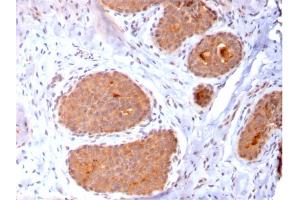 Formalin-fixed, paraffin-embedded human Breast Carcinoma stained with HSP60 Mouse Monoclonal Antibody (CPTC-HSPD1-1). (HSPD1 抗体)