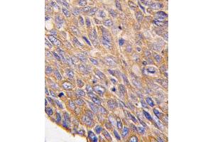Formalin-fixed and paraffin-embedded human lung carcinoma tissue reacted with TOB2 antibody (N-term) (ABIN390219 and ABIN2840699) , which was peroxidase-conjugated to the secondary antibody, followed by DAB staining. (TOB2 抗体  (N-Term))