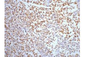 Immunohistochemistry (IHC) staining of Human small cell carcinoma of lung tissue, diluted at 1:200. (ENO2/NSE 抗体)