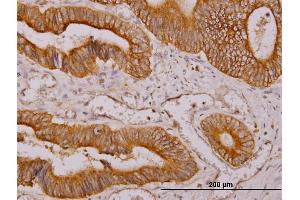 Immunoperoxidase of monoclonal antibody to NDRG4 on formalin-fixed paraffin-embedded human colon adenocarcinoma. (NDRG4 抗体  (AA 1-339))