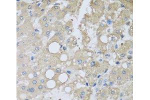 Immunohistochemistry of paraffin-embedded Human liver damage using CHMP1B Polyclonal Antibody at dilution of 1:100 (40x lens). (CHMP1B 抗体)