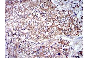 Immunohistochemical analysis of paraffin-embedded lung cancer tissues using NEFL mouse mAb with DAB staining. (NEFL 抗体)