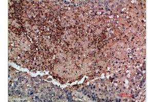 Immunohistochemical analysis of paraffin-embedded human-lung-cancer, antibody was diluted at 1:200 (DDR2 抗体  (AA 31-80))