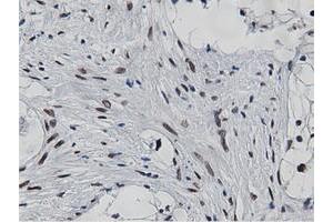 Immunohistochemical staining of paraffin-embedded Carcinoma of Human kidney tissue using anti-NT5DC1 mouse monoclonal antibody. (NT5DC1 抗体)