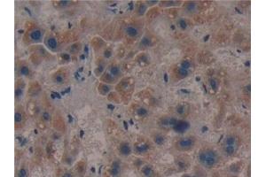 Detection of CS in Human Liver cancer Tissue using Polyclonal Antibody to Citrate Synthase (CS) (CS 抗体  (AA 103-394))