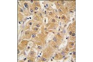 Formalin-fixed and paraffin-embedded human hepatocarcinoma tissue reacted with APOA5 antibody (N-term), which was peroxidase-conjugated to the secondary antibody, followed by DAB staining. (APOA5 抗体  (N-Term))