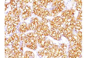 Formalin-fixed, paraffin-embedded human Renal Cell Carcinoma stained with PNA Mouse Monoclonal Antibody (PN-15). (CA9 抗体)