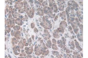 DAB staining on IHC-P; Samples: Human Breast cancer Tissue) (CCL20 抗体  (AA 27-96))