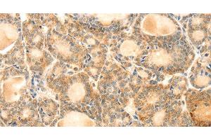 Immunohistochemistry of paraffin-embedded Human thyroid cancer using EVA1A Polyclonal Antibody at dilution of 1:30 (TMEM166 抗体)