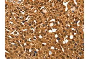 The image on the left is immunohistochemistry of paraffin-embedded Human breast cancer tissue using ABIN7192644(SRGAP1 Antibody) at dilution 1/25, on the right is treated with synthetic peptide. (SRGAP1 抗体)