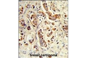 Formalin-fixed and paraffin-embedded human breast carcinoma reacted with NCF1C Antibody (C-term), which was peroxidase-conjugated to the secondary antibody, followed by DAB staining. (NCF1C 抗体  (C-Term))