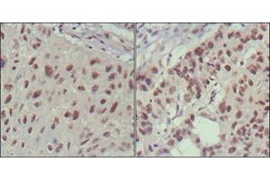 Immunohistochemical analysis of paraffin-embedded human lung cancer (left) and cervical carcinoma (right), showing nuclear localization using ISL1 mouse mAb with DAB staining. (ISL1 抗体)