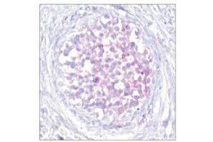 Immunohistochemical analysis of paraffin-embedded human breast carcinoma tissue using Raf-1 (phospho-Ser259) antibody (E011006). (RAF1 抗体  (pSer259))