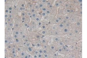Detection of SPTAN1 in Human Liver cancer Tissue using Polyclonal Antibody to Alpha-Fodrin (SPTAN1) (SPTAN1 抗体  (AA 289-408))