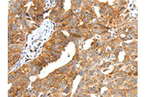 The image on the left is immunohistochemistry of paraffin-embedded Human ovarian cancer tissue using ABIN7192287(SCT Antibody) at dilution 1/40, on the right is treated with synthetic peptide. (Secretin 抗体)