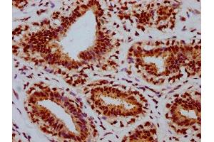 IHC image of ABIN7127740 diluted at 1:100 and staining in paraffin-embedded human breast cancer performed on a Leica BondTM system. (Recombinant Retinoblastoma 1 抗体  (pSer780))