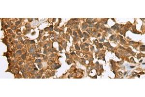 Immunohistochemistry of paraffin-embedded Human ovarian cancer tissue using YBX1 Polyclonal Antibody at dilution of 1:25(x200)