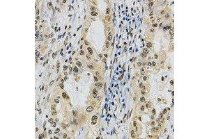 Immunohistochemical analysis of POLR3A staining in human lung cancer formalin fixed paraffin embedded tissue section. (POLR3A 抗体  (N-Term))