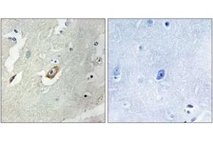 Immunohistochemistry analysis of paraffin-embedded human breast carcinoma tissue, using CDC16/APC6 (Ab-560) Antibody. (CDC16 抗体  (AA 526-575))